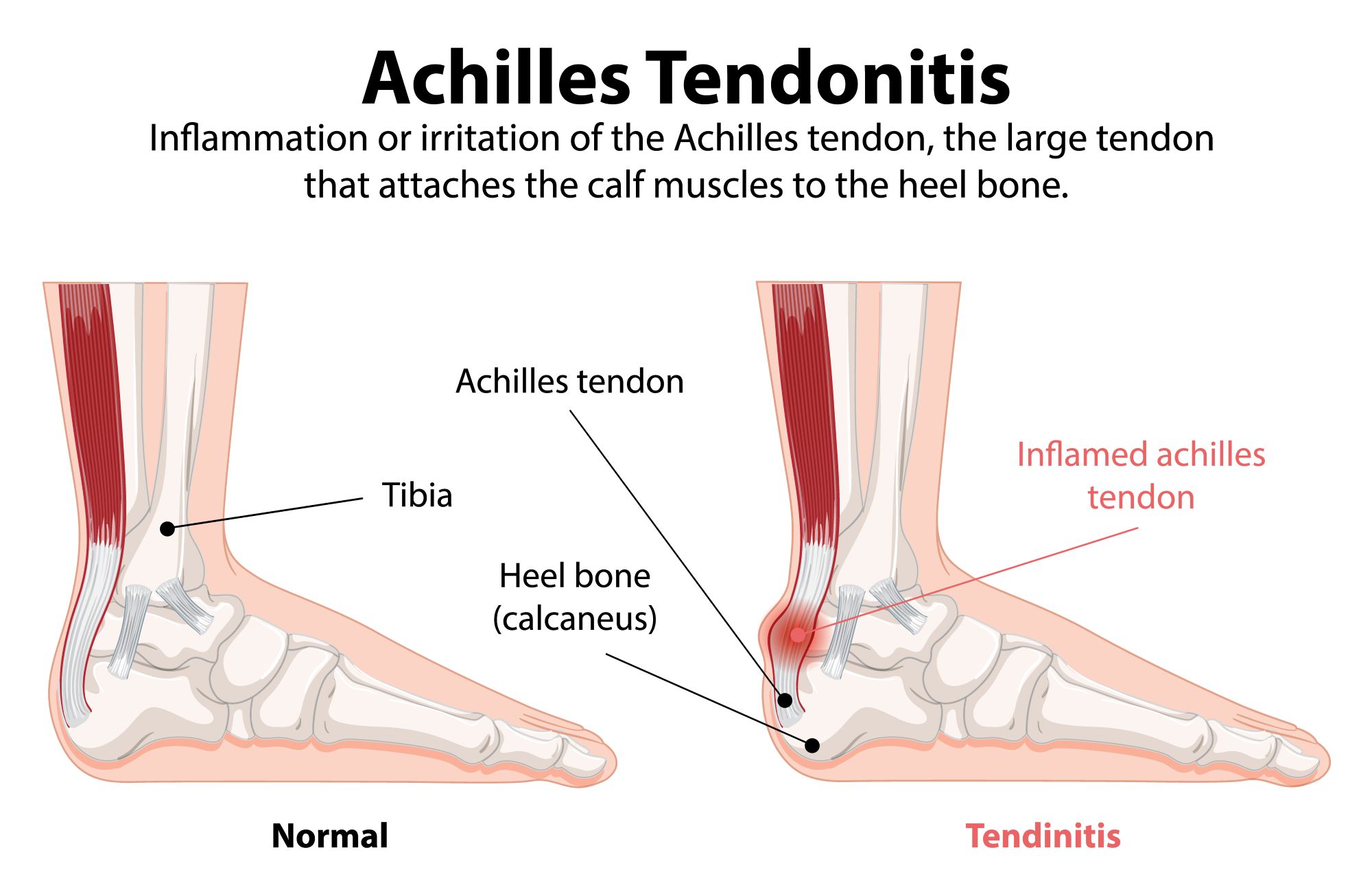 Graphic of two feet, the first showing a normal foot, and the second showing tendonitis. It highlights an inflamed Achilles tendon.