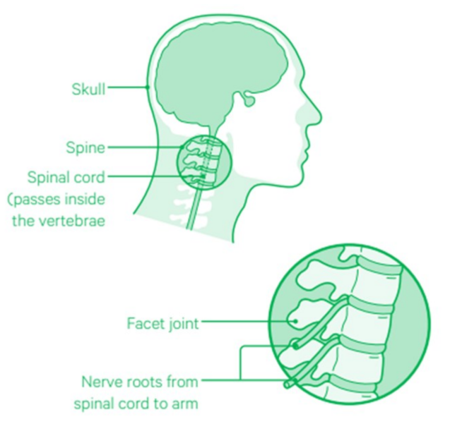 A diagram outline the head, with lines putting to the skull, the spine and the spinal cord. A zoomed in diagram of the spine points to the facet joint and nerve roots from the spinal cord to the arm.